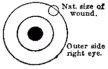 [Diagram of Eye: Nat. Size of wound. Outer side right eye.]